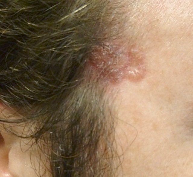 Basal cell carcinoma (BCC)