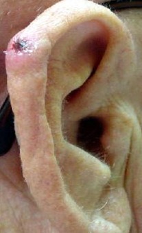 Basal cell carcinoma (BCC)