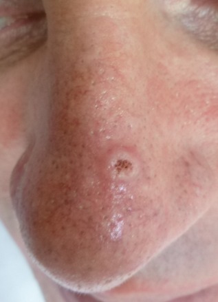 Basal cell carcinoma (BCC)
