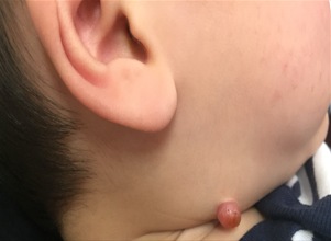 Pyogenic granuloma on the jawline