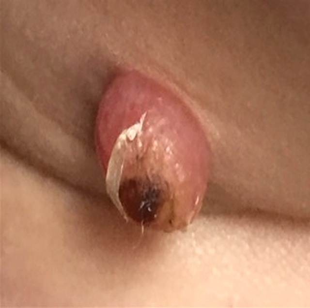 Pyogenic granuloma