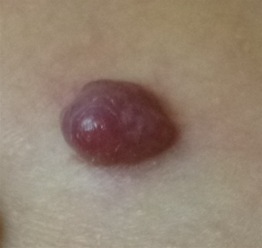 Pyogenic granuloma