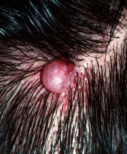 Pyogenic granuloma on the scalp
