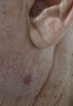 Basal cell carcinoma (BCC)