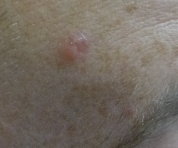 Basal cell carcinoma (BCC)