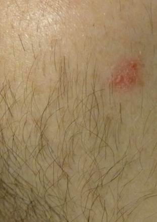 Basal cell carcinoma (BCC)