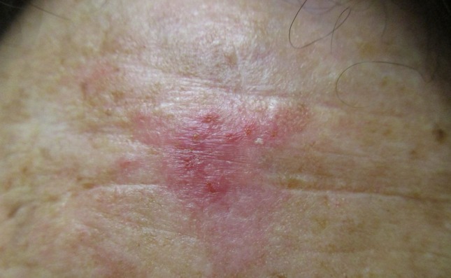 Squamous cell carcinoma (SCC)