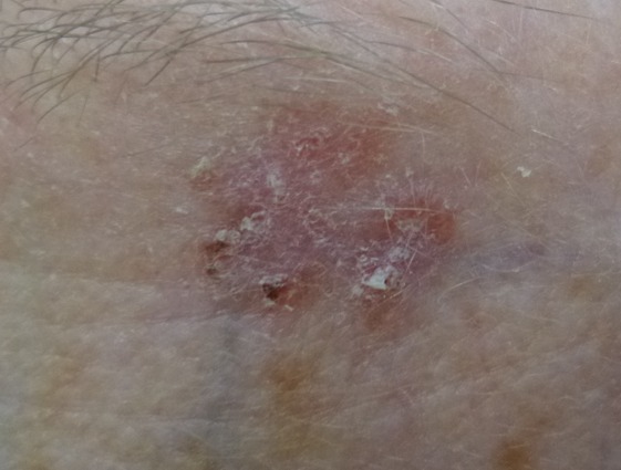Squamous cell carcinoma in situ (SCC in situ)
